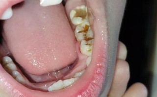 儿童坏牙牙根外露是什么原因导致的？如何有效预防与治疗？