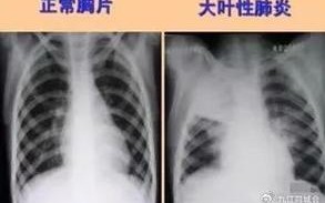 新生儿肺部拍片真的安全吗？辐射风险到底有多大？