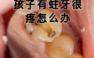 孕期蛀牙引发牙神经痛，到底该怎么办才能不伤胎儿？