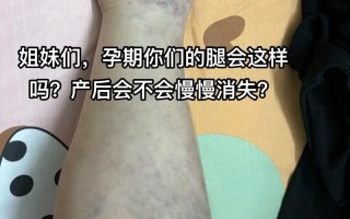 怀孕期间血管鼓起来了