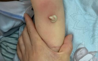 新生儿硬肿症硬肿最初出现在哪里？