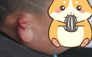 新生儿耳朵受压变形后能自行恢复吗？家长需要如何护理才不会影响正常发育？