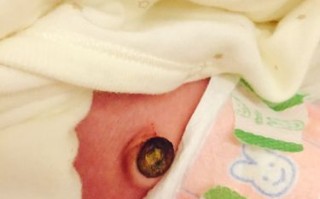 新生儿第七天肚脐出血正常吗？该如何护理和处理？