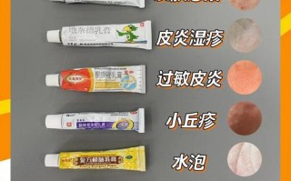 孕期汗疱疹用药安全吗？哪些外用药物不影响胎儿健康？