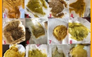 新生儿拉肚子大便图能准确区分生理性腹泻与病理性腹泻吗？