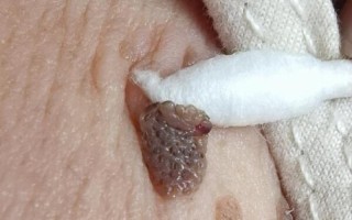 怀孕期间胸上长小肉粒