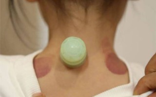 儿童咳嗽拔罐图片大全