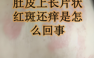 怀孕期间肚皮痒且有红点，是皮肤问题还是妊娠特殊反应？