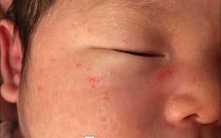 新生儿脸上红血丝是正常现象还是疾病信号？如何区分生理性与病理性红血丝？