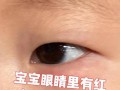 新生儿白眼球出现红点是何原因？需要警惕哪些眼部问题？