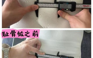 孕期耻骨分离产后多久能恢复？