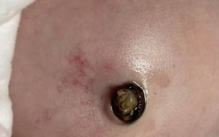 新生儿脐带上的白色橡皮圈到底有什么作用？需要多久才能自然脱落？