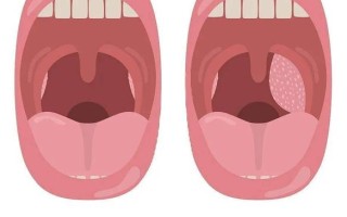 儿童扁桃体大小图怎么看？不同年龄段正常范围是多少？