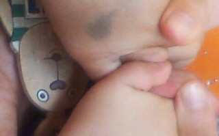 新生儿手背青胎记是先天形成还是后天因素导致？需要干预治疗吗？