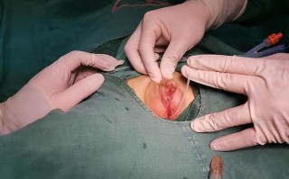 新生儿尿道口下裂手术最佳时机是什么？术后护理要注意哪些问题？