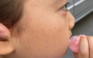 新生儿脸上红点点图片是湿疹还是痤疮？该如何正确处理和护理？