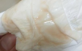 早孕期白带粘稠如鼻涕是正常现象还是异常信号？