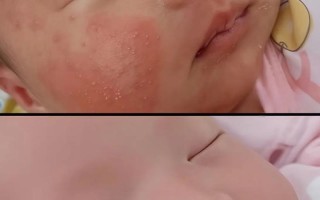 新生儿痤究竟能不能擦面霜？哪种面霜适合？擦了会不会加重？