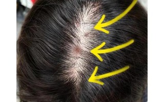 孕期头皮痘痘频发又不敢用药，这到底该怎么办才安全？