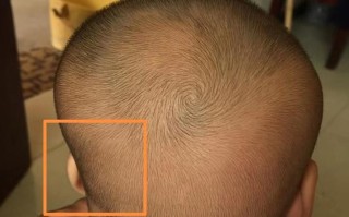 新生儿脑袋一侧出现凹陷是正常现象还是异常信号？需要警惕哪些潜在问题？