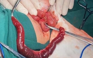 新生儿肠重复畸形手术的时机、风险及术后护理该注意什么？