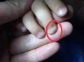 儿童手指甲起层是缺乏营养还是疾病信号？附图片详解原因及应对方法