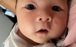 新生儿眼睛一大一小是何原因？
