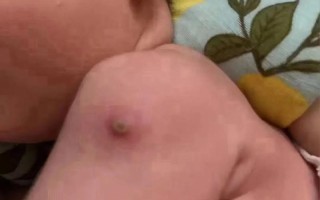 新生儿预防针化脓是正常现象吗？图片显示这种情况该如何处理？