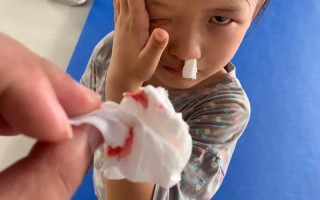 儿童高烧后为何会鼻子流血？是正常现象还是疾病信号？