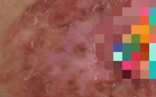 孕期乳晕小肉粒是何原因？