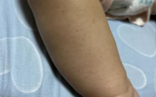 新生儿全身皮肤网状紫红色是何原因？