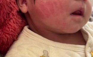 新生儿脸上长黄色结痂是湿疹还是痂皮？该怎么正确处理和护理？