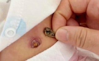 新生儿肚脐脱落前后护理要注意什么？图片中的正常状态该咋判断？