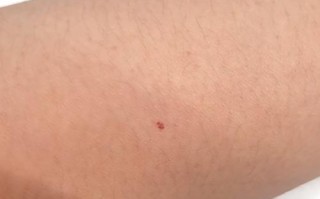 儿童为何易长蜘蛛痣？背后肝脏健康或激素水平异常有何关联？