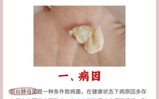 孕期霉菌感染后能否自愈？会对胎儿造成影响吗？