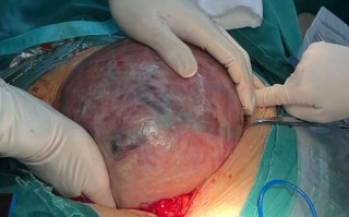 怀孕期间发现子宫肌瘤，会影响胎儿健康和分娩方式吗？