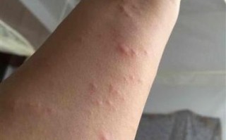 孕期病毒感染什么症状