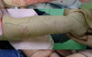 儿童血象高有哪些症状表现？