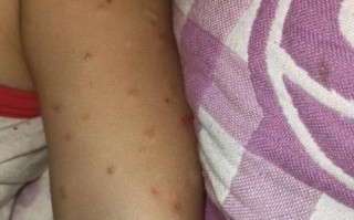 儿童链球菌皮炎图片有哪些典型症状？如何与其他皮肤问题区分？