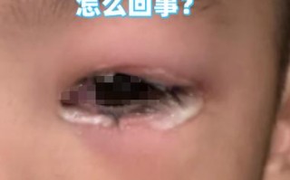 新生儿泪囊炎和结膜炎如何区分？护理上要注意什么？