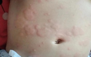 儿童感染弓形虫的症状