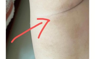 怀孕期间大腿内侧变黑是激素变化还是营养不良？