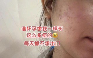 孕期长粉刺怎么办？