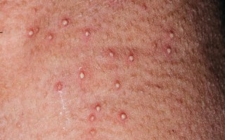 孕期身上起疙瘩却不痒，是正常现象还是身体异常信号？