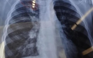 新生儿肺部阴影是何原因？