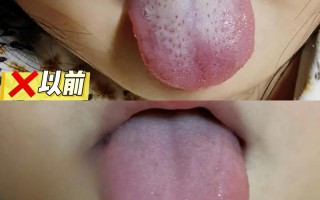 新生儿母乳喂养舌苔发白是何原因？