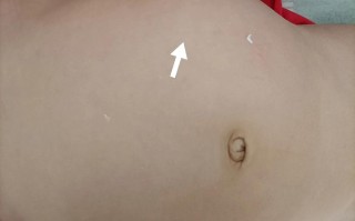 新生儿肾上腺母细胞瘤早期症状隐匿，家长该如何识别与应对？