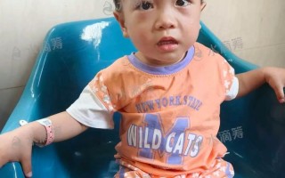 儿童急性白血病早期症状有哪些？