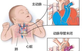 新生儿动脉导管何时能自然闭合？