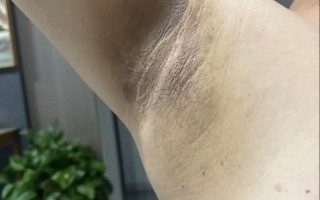 孕期腋窝发黑是激素变化还是身体异常信号？需关注哪些健康问题？